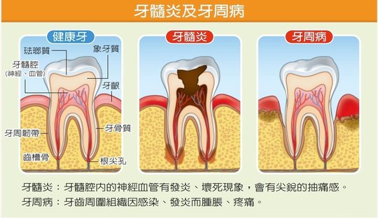 牙髓炎.牙周病.jpg