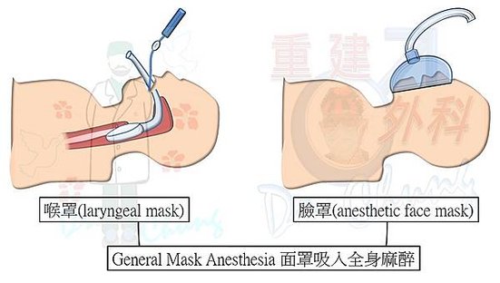 面罩吸入全身麻醉.jpg