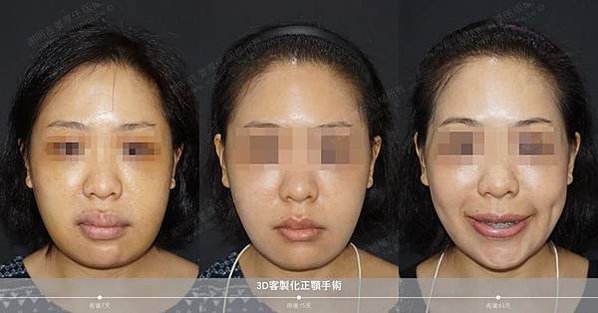 謝明吉 正顎手術 恢復週記