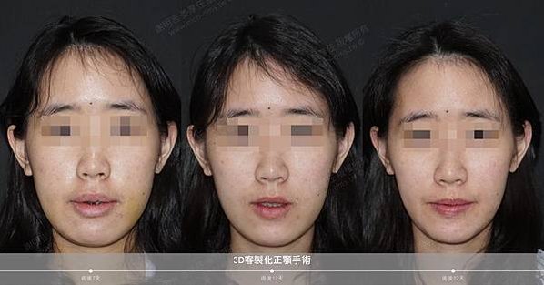 謝明吉 正顎手術 恢復週記