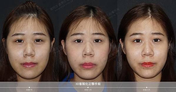 謝明吉 正顎手術 恢復週記