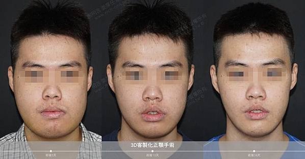 謝明吉 正顎手術 恢復週記