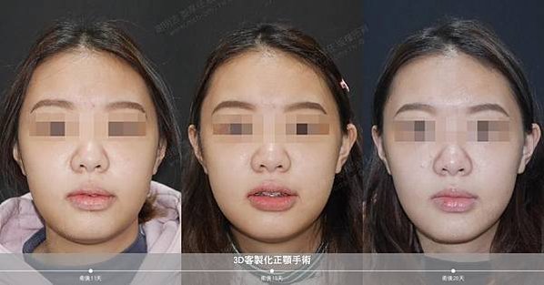 謝明吉 正顎手術 恢復週記