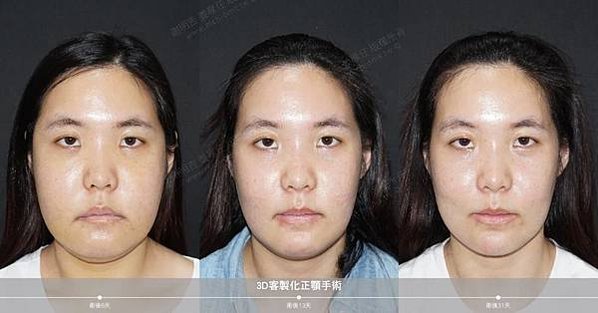 謝明吉 正顎手術 恢復週記