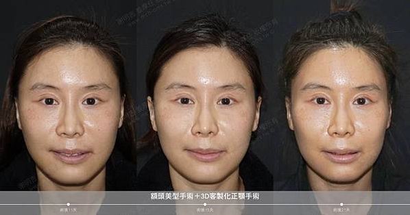謝明吉 正顎手術 恢復週記