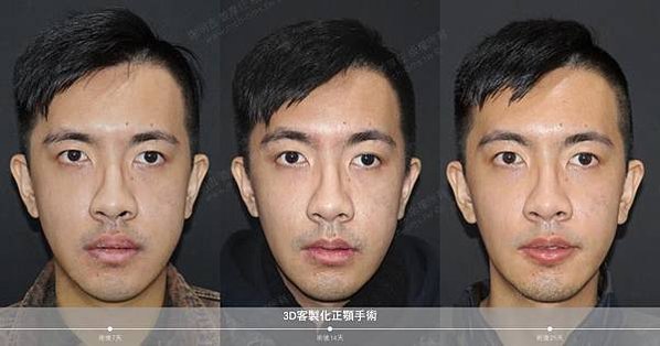 謝明吉 正顎手術 恢復週記