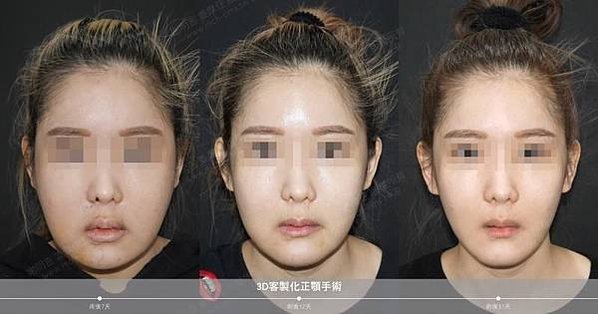 謝明吉 正顎手術 恢復週記