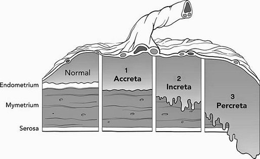 accreta degrees, page2anesthesiology.org.jpg