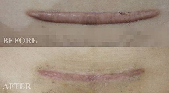 剖腹產疤痕蟹足腫治療