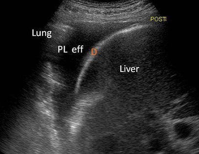 Pleural effusion 2