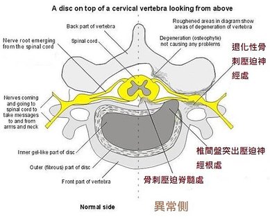 Cervial-radiculopathy-2.jpg