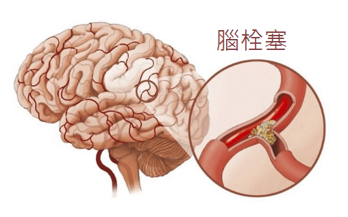 趙露思患失語症！失語症腦中風的密切關係－語言能力受損的原因與