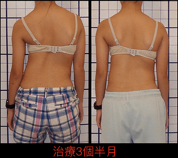 scoliosis posture change from 63.png