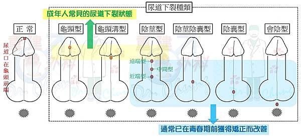 尿道下裂種類.jpg