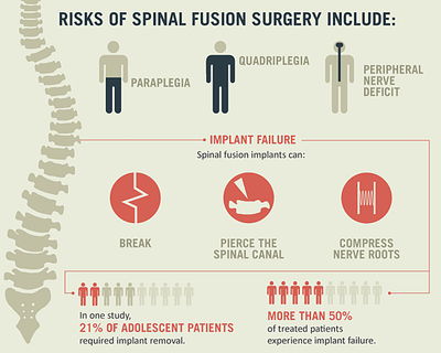 spinal-fusion-surgery-risks.png