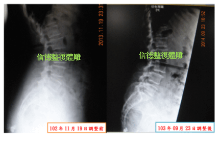 脊椎滑脫