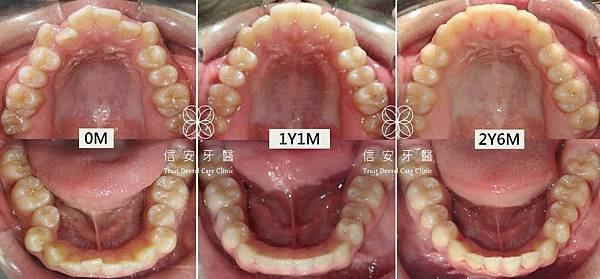 brackets-vs-invisalign-1504120716-9977.jpg