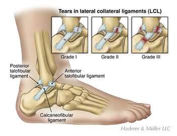 ankle sprain grades.jpg