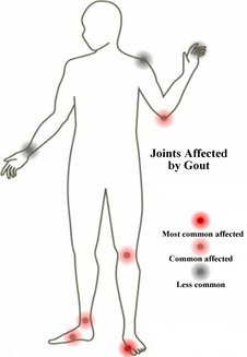 common_joints_affected_by_gout.jpg