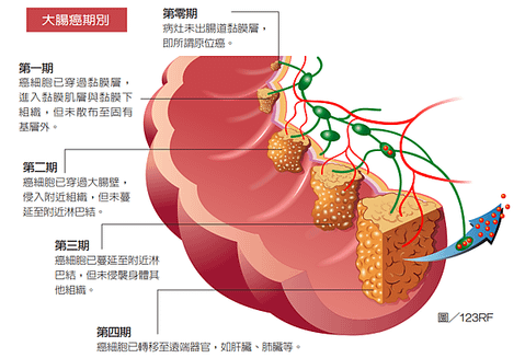 益生菌對大腸癌的影響