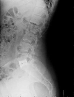 anterior-lumbar-interbody-fusion-ALIF.jpg