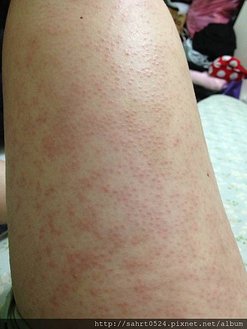 胎毒腿部