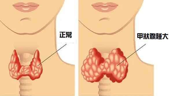 甲狀腺腫大相關一些症狀-台北甲狀腺高階檢測