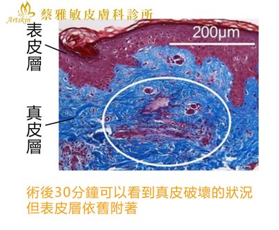 刺激膠原蛋白新生.jpg