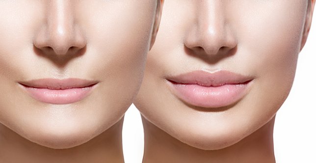 lip-augmentation.jpg