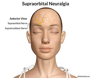 Supraorbital-Neuralgia.jpg