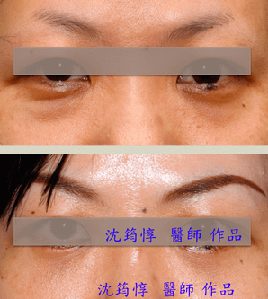眼袋內開 VS 眼袋外開-作者沈筠惇