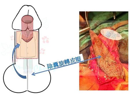 陰囊旋轉皮瓣.jpg