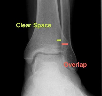 Ankle AP Measurements.jpg