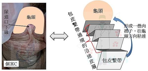 包皮環切前後的繫帶變化--個案探討(上) (The case
