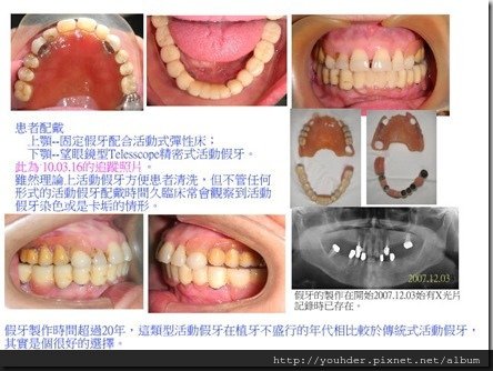 上顎彈性床和下顎望眼鏡型精密式活動假牙之追蹤記錄