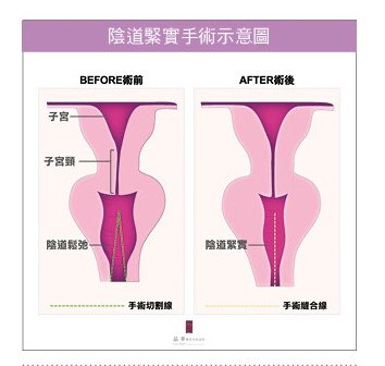 晶華美醫診所 私密處整形 陰道緊實手術 陰道鬆弛 張子倩醫師