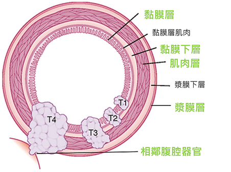 大腸癌~2.PNG