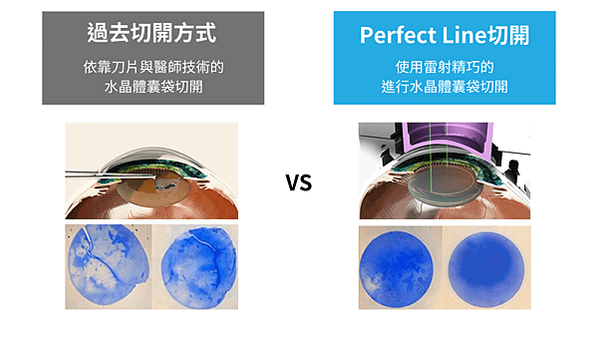 雷射多焦點白內障