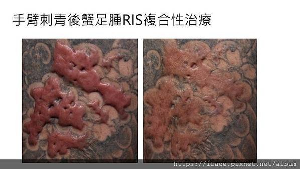 【除疤】無法切除之蟹足腫｜巨大蟹足腫治療｜治療蟹足腫│疤痕疙