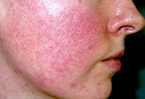 ali-ghahary-rosacea.jpg