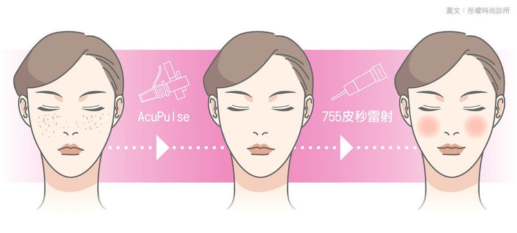 AcuPulse價格AcuPulse副作用AcuPulse痘疤AcuPulse高雄AcuPulse多久打一次AcuPulse術後AcuPulse凹洞AcuPulse保養超脈衝雷射 (4).jpg