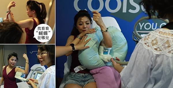 Coolsculpting-lily-3