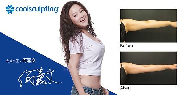 Coolsculpting-Vivi Ho-4-01