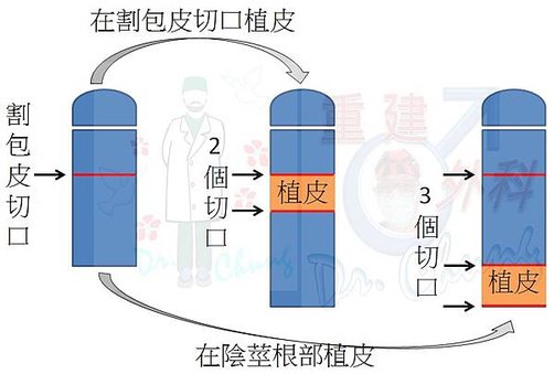 一般陰莖的植皮位置.jpg