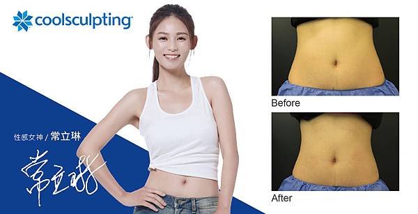 Coolsculpting-Chloe-4-01