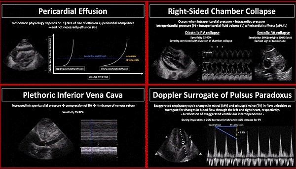 Cardiac Tamponade