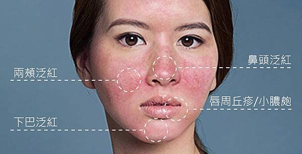 Doctor-Rosacea-2