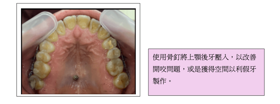 「牙齒矯正」一定要打骨釘嗎？會不會很痛？