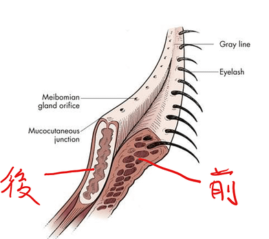 【眼袋修復/眼袋外翻修正】眼袋開完下眼皮外翻了，怎麼辦？-作