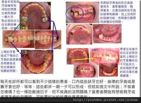 缺牙不做的代價